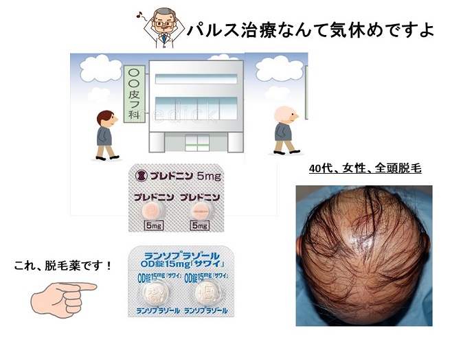 円形脱毛症　病院